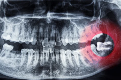 toothache