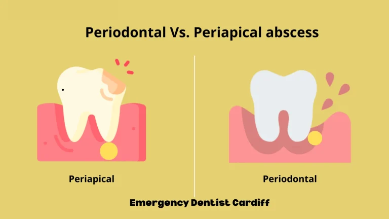 Periodontal Abscess and Periapical Abscess