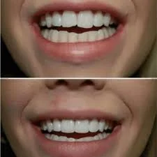 After composite bonding