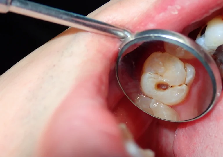 early signs of dental infection