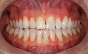 Patient 45 years before after whitening