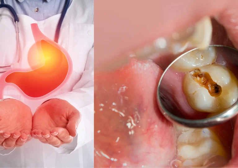 Link-Between-Acid-Reflux-and-Tooth-Erosion