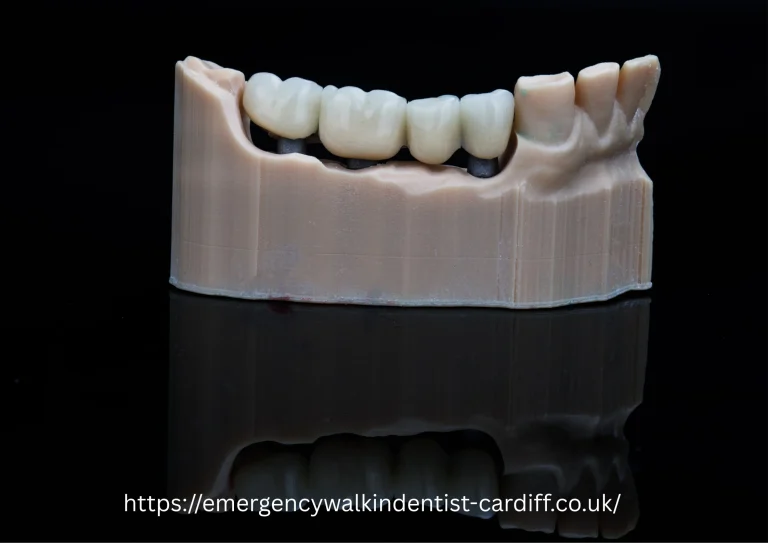Dental Bridge Breaks